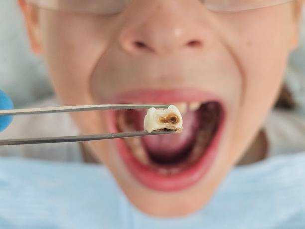 Best Emergency Broken Tooth Repair in Combine, TX